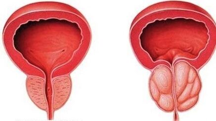 normalna i upaljena prostata
