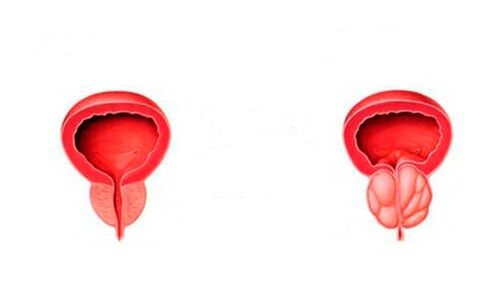 zdrava i upaljena prostata s prostatitisom
