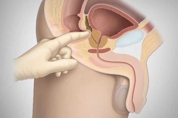 Masaža prostate za bakterijski prostatitis