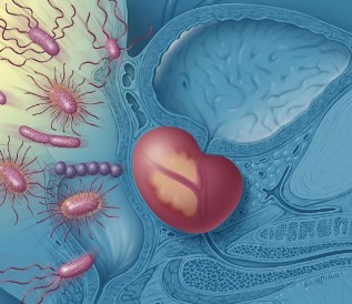 Upala prostate