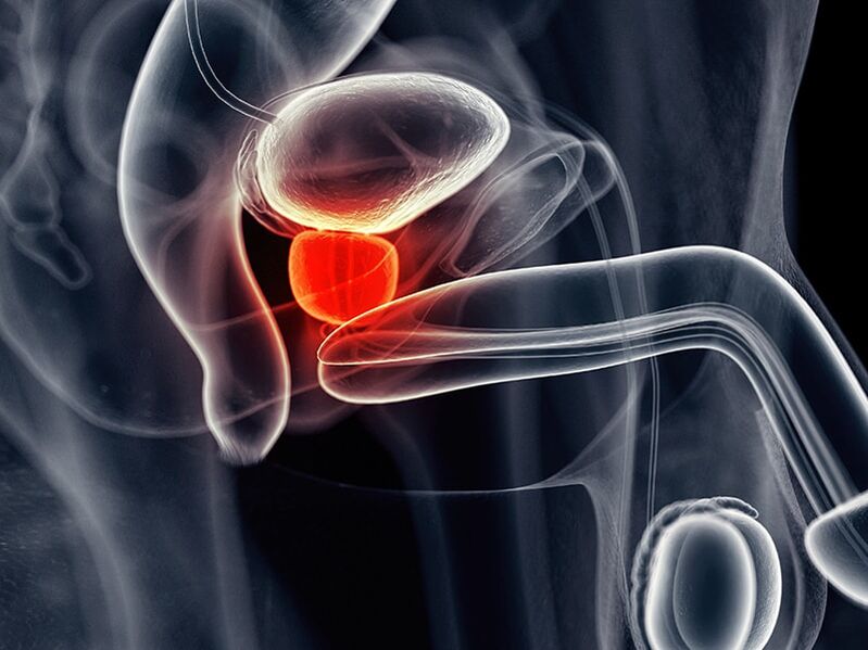 Upala prostate koja prati kronični prostatitis